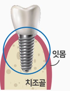 치조골에 단단히 자리 잡은 임플란트 단면 그림