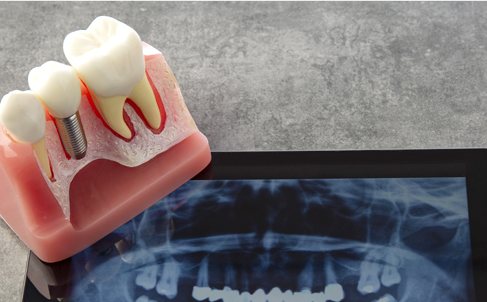 임플란트 치아 모형과 파노라마 X-ray 를 띄운 태블릿