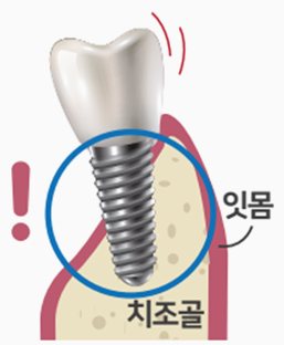 치조골이 부족해 흔들리는 임플란트 단면(빨간 느낌표, 표시 글 잇몸·치조골)