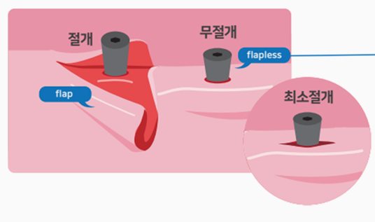 잇몸 단면에서 절개(flap)·무절개(flapless)·최소절개 비교 그림
